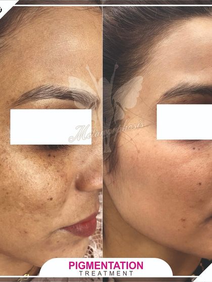 Another angle showing the impressive results of our pigmentation treatment, highlighting the clearance of sun damage and age spots.