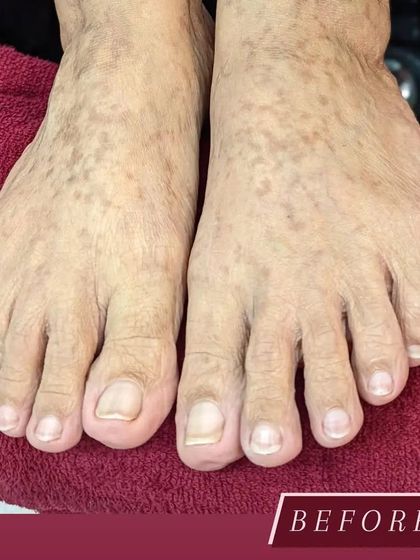 This is the "before" shot, showing the client's feet prior to our rejuvenating pedicure service. This is the starting point for our transformation to healthier, more beautiful feet.