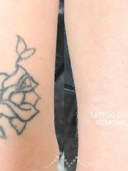 An outline of a rose tattoo on the arm, successfully removed. Outline tattoos often respond well to laser treatment.