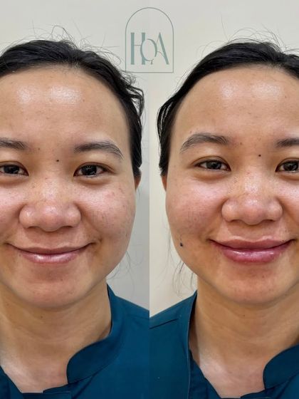 A full-face view of a subtle lip filler transformation. The goal was to enhance her natural beauty by balancing her features and adding a touch of hydration to the lips, resulting in an overall refreshed look.