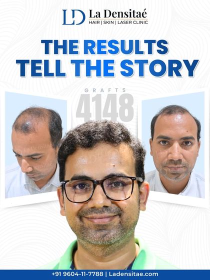 A few months ago, this patient was struggling with hair loss. Today, after a 4,148-graft transplant, he has a full, natural-looking hairline and a renewed sense of self. This is the power of real results from expert care.