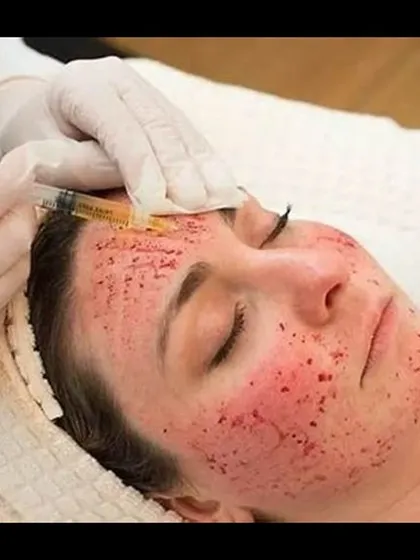 This image captures the process of a Vampire Facial, where PRP is applied across the skin to stimulate widespread collagen production. It's a fantastic treatment for overall skin revitalization.