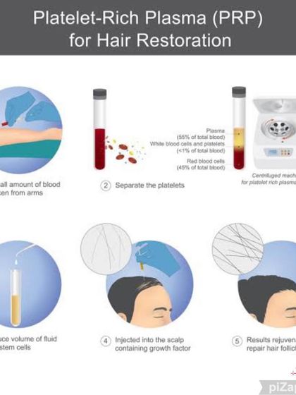A detailed medical illustration of the Platelet-Rich Plasma (PRP) process for hair restoration. It shows how a small amount of blood is processed to separate the platelets, which are then injected to repair and rejuvenate hair follicles.