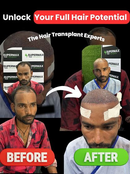 Before and after with 3500 grafts. This is what you can achieve with an affordable package and expert hands.