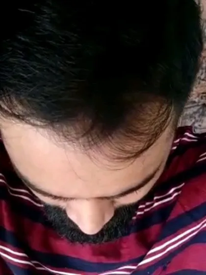 This image shows a typical case of male pattern baldness with thinning at the crown and a receding hairline. This is the kind of hair loss that I effectively treat using GFC and PRP therapies to restore density.