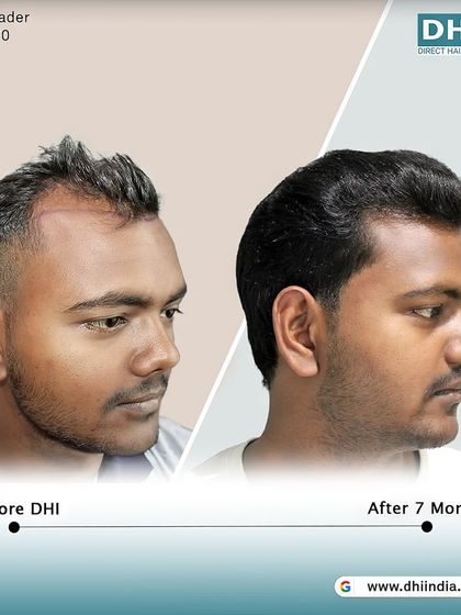 A side-profile view of a 20-year-old client 7 months after his DHI procedure. The image shows a restored, age-appropriate hairline and a significant increase in density.