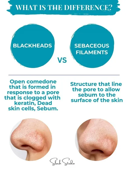 Do you know the difference between blackheads and sebaceous filaments? This graphic breaks it down so you can better understand and treat your skin.