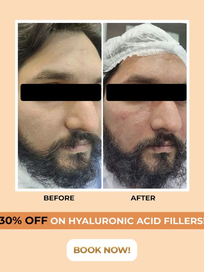 This before and after photo demonstrates the effectiveness of our Hyaluronic Acid fillers. Notice the significant improvement in facial volume and the reduction of deep-set lines, resulting in a naturally refreshed and more youthful appearance for our client.