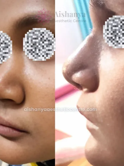 A well-proportioned nose can bring harmony to the entire face. This before-and-after image shows a rhinoplasty result where the nose has been refined to better suit the patient's facial features, creating a balanced and natural profile.