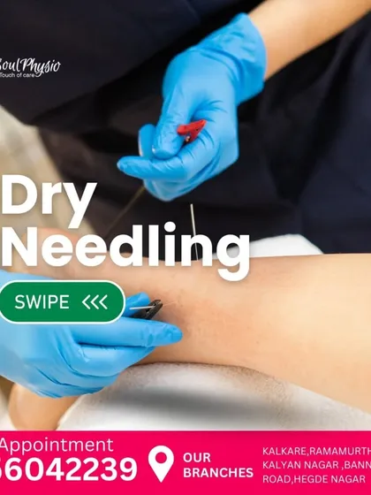 Dry needling is a modern technique we use to treat muscle pain. By inserting a thin needle into a trigger point, we can release tightness and improve muscle function.