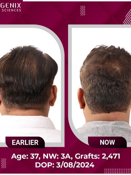 The confident smile of this 37-year-old after his 2471-graft procedure says it all.