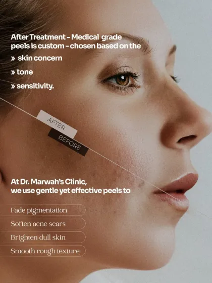 This graphic illustrates the corrective power of medical-grade chemical peels. I use gentle yet effective formulations to fade pigmentation, soften acne scars, and smooth rough texture, customizing the treatment based on each patient's specific skin concern, tone, and sensitivity.