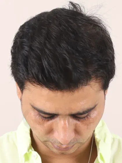 A 20-month transformation for a Diffuse Grade 5A patient. With 3800 grafts, we restored his hairline, frontal region, and mid-scalp for a lasting, natural look.