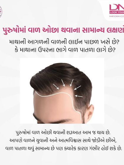 This image illustrates the common signs of male pattern baldness, such as a receding hairline and thinning at the crown. While hair thinning is common, it can sometimes have serious underlying causes that need to be checked.