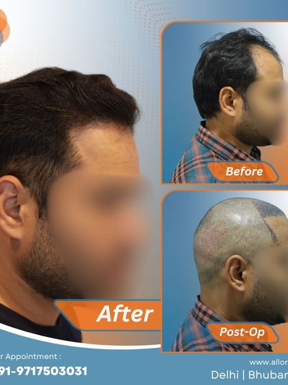 This series shows the complete process for a patient, from the before and post-op stages to the final impressive result. It gives a comprehensive view of the transformation journey.