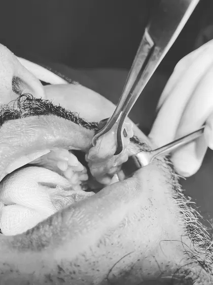 This clinical image shows the buccal fat pad being removed through a small incision inside the mouth. This procedure, known as buccal fat excision, is designed to reduce cheek fullness and create a slimmer, more chiseled facial appearance.