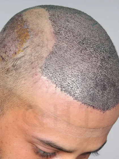 A look at the graft placement for a Norwood Grade 6 case. 5400 grafts were used to recreate the hairline, frontal part, mid-scalp, and crown.