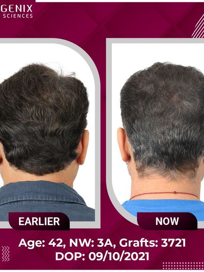 TV Actor Romanch Mehta shows his incredible transformation and explains how our results convinced him to overcome his fear of surgery.