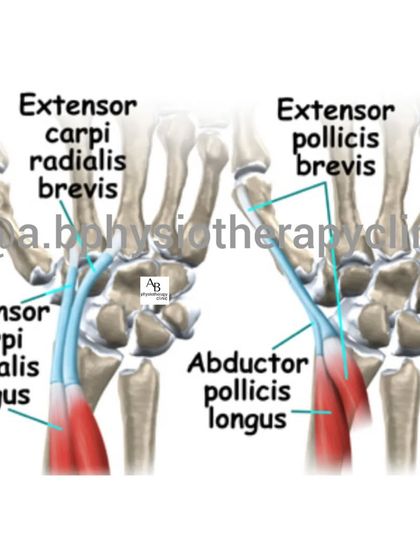 A detailed anatomical view of the tendons involved in Intersection Syndrome. Understanding this anatomy allows us to provide precise and effective treatment.