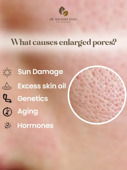 Enlarged pores are a common textural concern resulting from various factors. These include sun damage which degrades collagen, excess sebum production, genetics, the natural aging process, and hormonal influences.