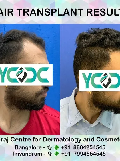 A side view capturing the new, denser hair growth. The texture and direction of the transplanted hair mimic natural growth patterns.
