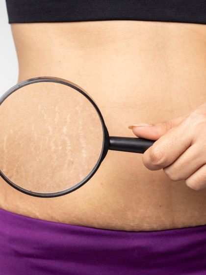 Stretch marks are a common concern that I treat with methods designed to improve skin quality and elasticity. This image highlights the issue, for which I offer solutions like microneedling and fractional lasers.