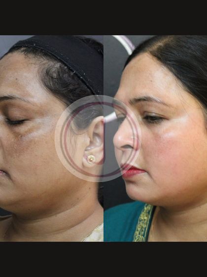 This side profile before and after highlights the effectiveness of depigmenting peels on the cheek and jawline. The treatment successfully reduced dark spots and evened out the skin tone for a smoother, more uniform appearance.