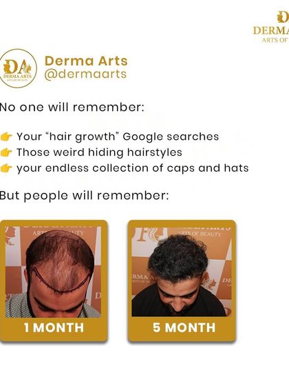 Forget the endless Google searches and hiding under hats. What people will truly remember is your confidence after a successful hair transformation. This five-month progress speaks for itself.