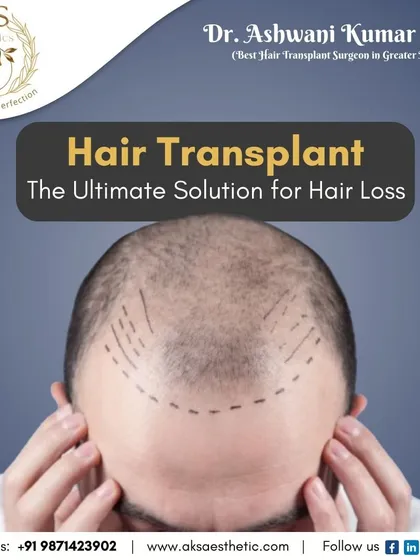 The first step in a hair transplant is careful planning. I mark the recipient area to create a natural and dense hairline, ensuring the final result is tailored specifically to you.