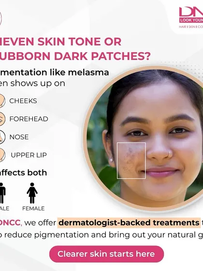 Pigmentation issues like melasma often appear as dark patches on the cheeks, forehead, and upper lip. At my clinic, I offer dermatologist-backed treatments tailored to your specific skin type to safely reduce pigmentation and restore an even, natural glow.