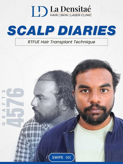 A closer look at Mr. Vishal’s journey. The "Scalp Diaries" branding highlights the personal and transformative nature of the hair restoration process, made possible with 4,576 carefully placed grafts.