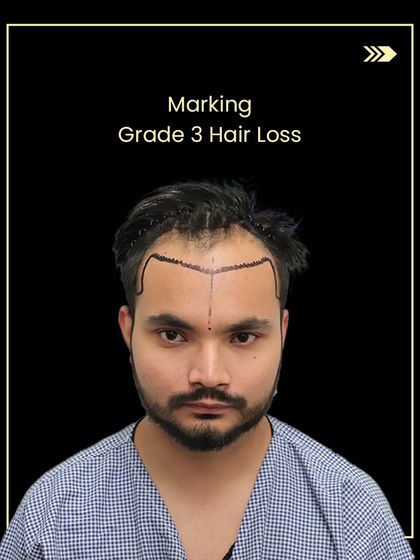 This is Ashish during the planning phase, with markings for his Grade 3 hair loss. This step is key to designing a natural-looking hairline.