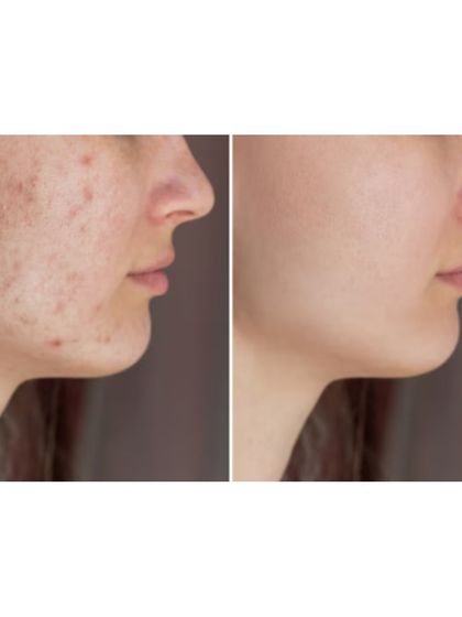 This image shows the successful outcome of a personalized acne scar treatment plan. I combine different technologies to ensure we address both pigmentation and texture for a complete result.