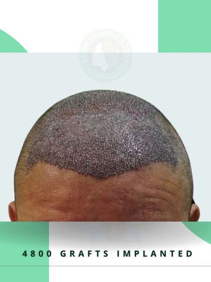 This image shows the result of 4800 implanted grafts. The entire balding area is covered with precision, laying the foundation for a complete and dense hair transformation.