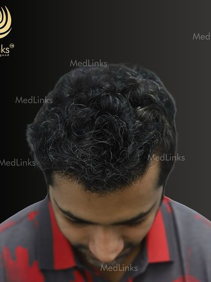 The top-down view after the transplant, showcasing the full coverage achieved.