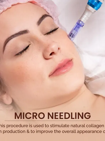 This image shows a microneedling procedure. I use this technique to create controlled micro-injuries that stimulate your body's natural production of collagen and elastin, improving the skin's overall appearance.