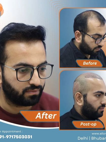 This series shows the full journey: the 'before' state with significant hair loss, the 'post-op' view with freshly implanted grafts, and the final 'after' result with a full, natural head of hair.