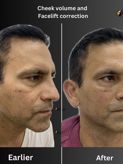 This image highlights the results of a cheek volume and facelift correction. By restoring volume to the mid-face, we achieve a natural lift that softens the entire face.