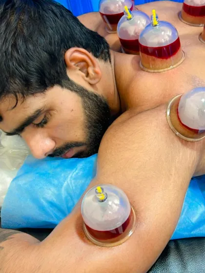 A close-up of a wet cupping (Hijama) detox session. This therapy is used to remove toxins from the blood, which can help with muscle recovery, pain relief, and even skin health.