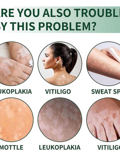 Vitiligo, or leukoplakia, can appear in various forms. I offer a range of treatments, from topical creams and phototherapy to surgical options for stable cases, to help restore pigment and confidence.