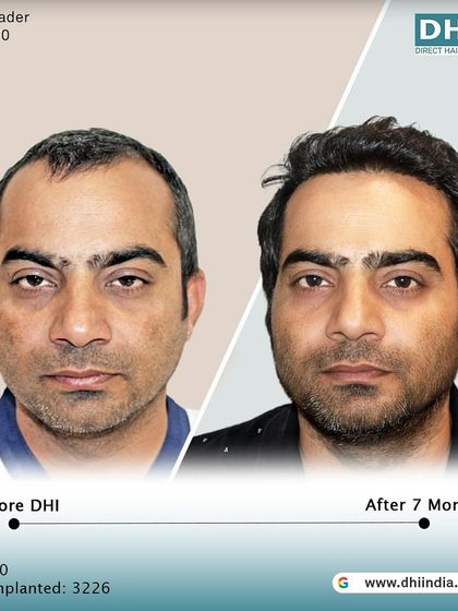 A frontal before and after of the 40-year-old client. The restored hairline and fuller appearance have given him a more youthful and confident look just 7 months after his procedure.