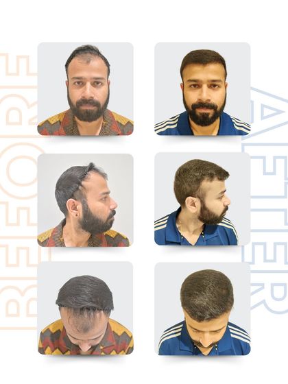 This six-panel grid shows Vikas's complete transformation. You can see how the 2,500 grafts restored his hairline from all angles, giving him a fuller and more youthful look that he can be confident about.