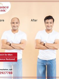 Non-Surgical Hair Replacement