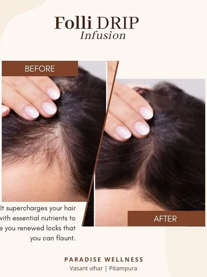 The results speak for themselves. This before and after showcases the transformative effect of our Folli IV Drip infusion. By delivering essential nutrients directly into the bloodstream, we supercharge hair follicles from within to promote renewed, thicker locks.