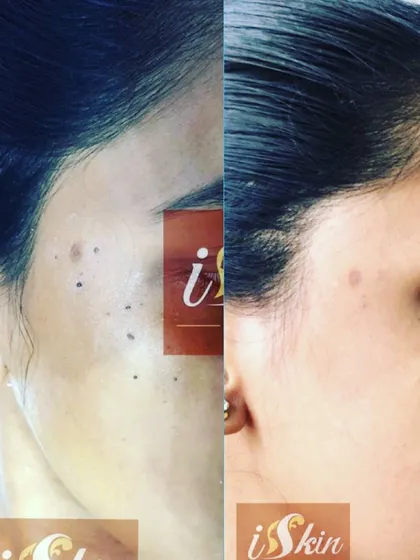 A successful non-surgical mole and spot removal using radiofrequency. The 'after' image shows the complete clearance of multiple dark spots from the patient's cheek, achieving a uniform and clear complexion with minimal downtime.
