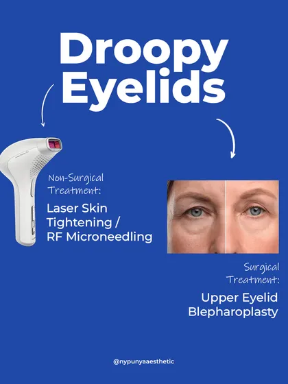For droopy eyelids, non-surgical laser or RF microneedling can help with early sagging. For more significant hooding, surgical upper eyelid blepharoplasty is the most effective treatment.