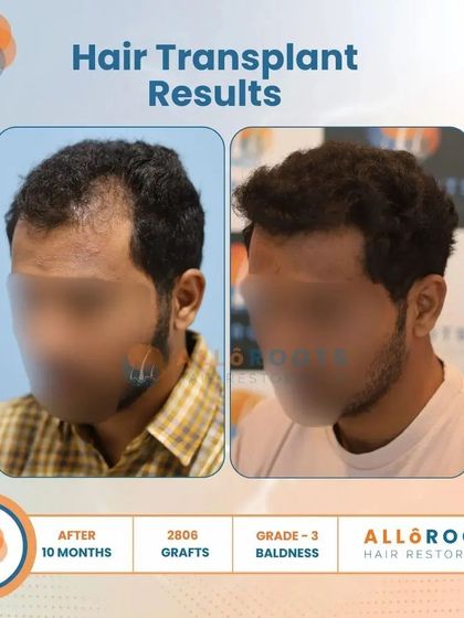 This 10-month result for a Grade 3 baldness case, using 2806 grafts, showcases a significant improvement in density and a perfectly restored hairline from all angles.