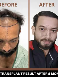 Hair Restoration and Treatment