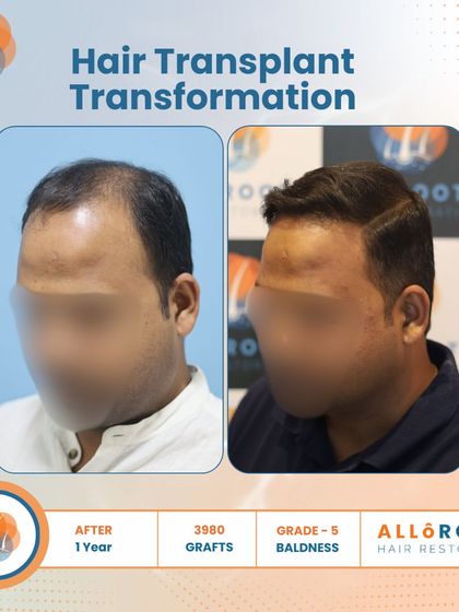 A one-year transformation for a Grade 5 baldness case using 3980 grafts. The images show the before, the immediate post-op, and the final result, demonstrating the entire process and its successful outcome.