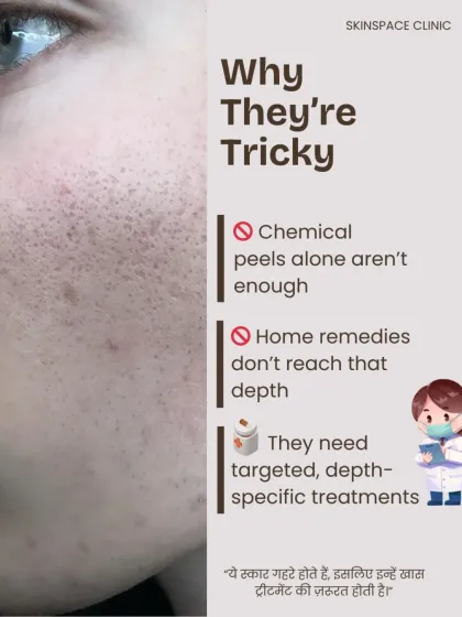 Ice-pick scars are tricky because home remedies can't reach the required depth and chemical peels alone are often not enough. They need targeted, depth-specific treatments that can rebuild the skin from the bottom up.